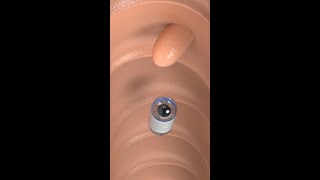 Capsule Endoscopy #science #shorts #medicine
