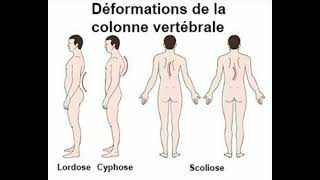 Les Déformations De La Colonne Vertebrale.