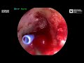 subannular ventilation tube t tube in a child