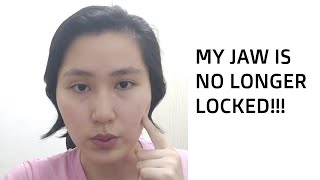 How Jennifer Unlocked Her Jaw without Surgery in only 2 months!