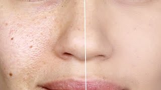 How to make Pores Disappear! | How to make Large Pores Vanish | Eman