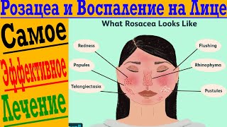 Розацеа, расширение сосудов, раздражение и угри на лице. Хронический воспалительный дерматоз!