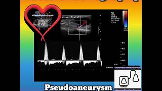 Pseudoaneurysm