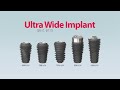 immediate placement after molar extrcation