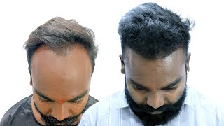 Cost & Results Of Hair Transplant In Raipur Chattisgarh