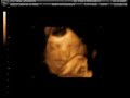 baby amber at 32 weeks 3d sonogram