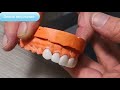 veneers ...فينيير