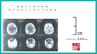 腎臟腫瘤長到3公分，才能申請用藥補助│3cm│紀錄片 紀錄觀點