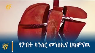 የጉበት ካንሰር መንስኤና ህክምናዉ