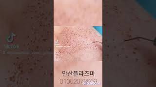 안산고잔동피부관리 플라즈마블라스트 메리미뷰티