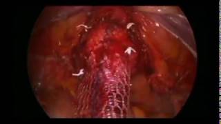 Vaginally Assisted Laparoscopic Sacrocolpopexy (VALS)