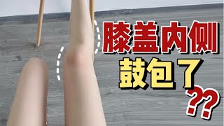 「膝蓋內側鼓包」要矯正？別讓身材焦慮再次升級！｜白白的實驗室