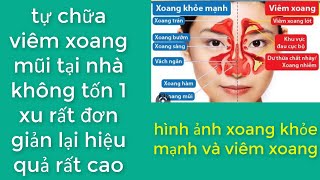 mẹo TỰ CHỮA VIÊM XOANG MŨI TẠI NHÀ KHÔNG TỐN 1 XU ! đơn giản  lại hiệu quả cao.