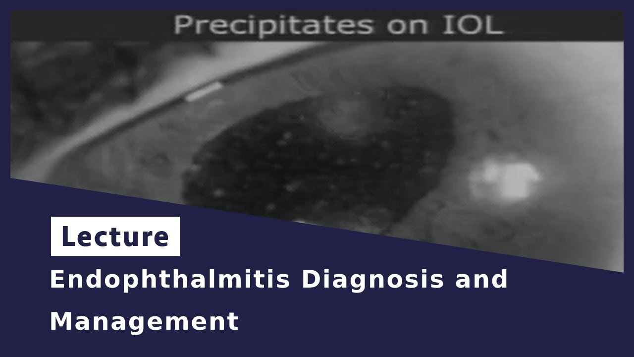 Endophthalmitis Diagnosis And Management - YouTube