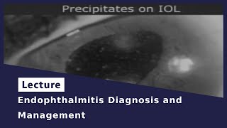 Endophthalmitis Diagnosis and Management