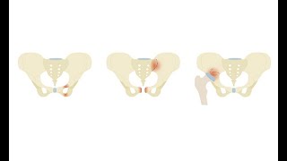 Investigating pelvic fractures on CT