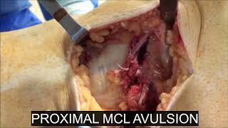 Patterns of Acute Medial Collateral Ligament Injury