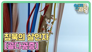 침묵의 살인자 [골다공증] 분쇄 골절이 더 위험한 이유는? MBN 230117 방송