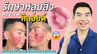 [Review] เลเซอร์รักษาหลุมสิว รอยสิว รักษาแผลเป็นคีลอยด์ ครั้งที่ 10