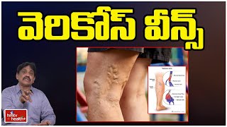 వెరికోస్ వీన్స్ l Varicose veins l hmtv Health