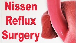 Nissen Fundoplication or Stomach Wrap to Treat Reflux Animation