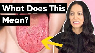 What Does a Cracked Tongue Mean? (Geographic Tongue & Fissured Tongue Explained)