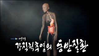 [명의 의학백과📖] 강직척추염의 동반질환