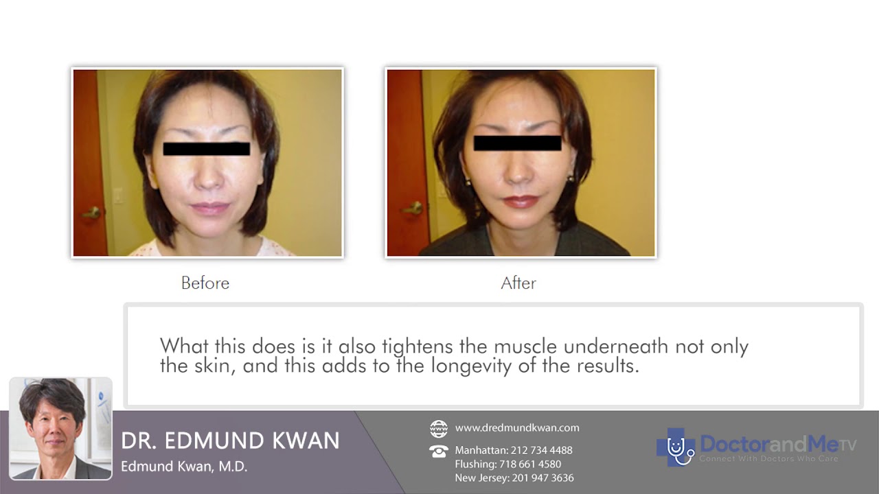 Types Of Facelifts - YouTube