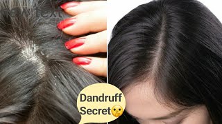 DANDRUFF को भगाएं सिर्फ इन 3 तरीकों से | How to remove Dandruff | Glow Yourself