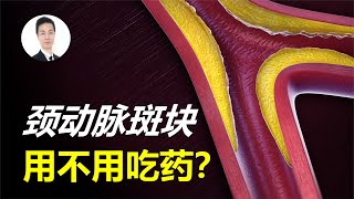 發現“頸動脈斑塊”就得吃降脂藥嗎？滿足三個條件，可以先不吃！发现“颈动脉斑块”就得吃降脂药吗？满足三个条件，可以先不吃！