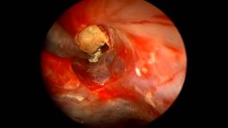 An endoscopic assisted retrosigmoid approach to the cerebello-pontine angle for resection