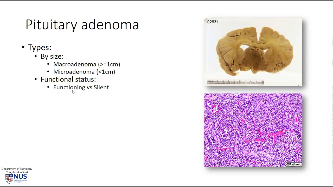 Brain: Pituitary Adenoma - YouTube