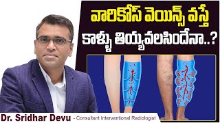 వారికోస్ వెయిన్స్  వస్తే | Causes and Treatment for Varicose Veins | Spider Veins | Dr Devu