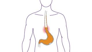 Nexium Control® - What is Heartburn?