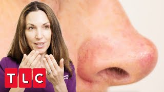 Woman's Nose Totally Reshaped By Massive Cyst | Bad Skin Clinic