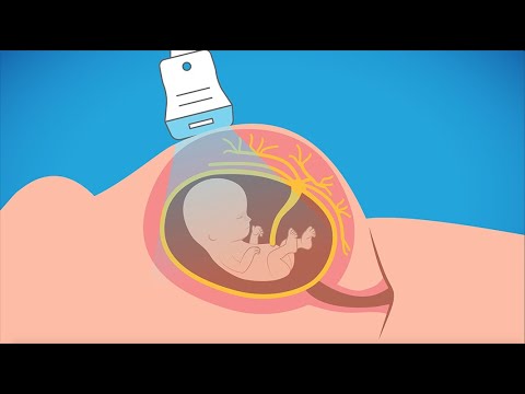 How can amniocentesis be used to screen for genetic disorders?