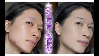 【YUKO嘉林】大红痘痘遮瑕法 | 痘痘怎么遮 | 完美底妆 | 痘痘瑕疵皮底妆