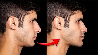 Plastic Surgeon Discusses Ron's Jaw Surgery