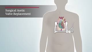 Aortic Stenosis Surgical Aortic Valve Replacement procedure