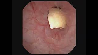 Laparoscopic Cholecystectomy with common bile duct exploration and choledochoscopy