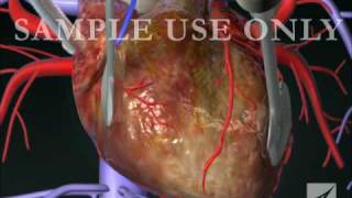 Coronary Artery Bypass Graft (CABG) Procedure