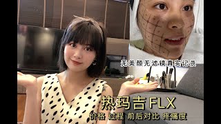 【新加坡热玛吉Thermage FLX全记录】价格，过程，前后对比，疼痛度