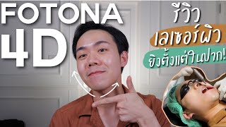 รีวิว Fotona 4D เลเซอร์ผิวครั้งแรก | Uncle Bank