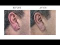 Cyst Removal. Before & After.