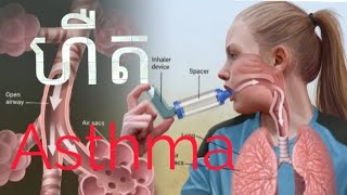 Asthma(ជម្ងឺហឺត) តើហឺតអាចព្យាបាលជាដែរឬទេ???