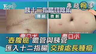 「壺腹癌」膽管與胰管匯入十二指腸　交接處長腫瘤｜TVBS新聞