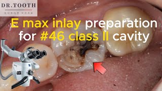 E max inlay prep for mandibular right first molar(#46) , 하악 우측 제1대구치 인레이 프렙과정