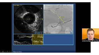 Watch Dr. Jimmy Kerrigan describe how he optimizes stents with IVUS