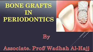 43- Periodontal surgery - 12  (Bone grafts) - Dr Wadhah Periodontology lectures.د/ وضاح الحاج