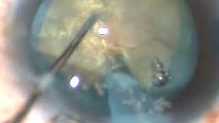 The Submarine Chop to crack hard cataract - P M, 27/10/2017